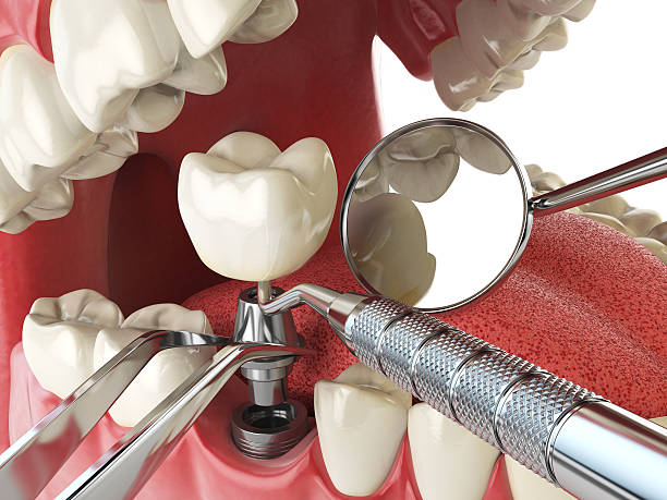 Best Emergency Tooth Extraction in Galveston, TX
